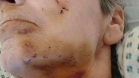 Idosa fica com ferimentos significativos no rosto após ser atacada na cama por ratazana 