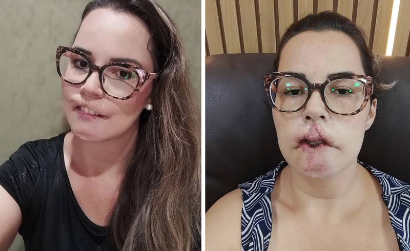 Mulher perde lábio superior após harmonização facial feita em troca de  divulgação – Metro World News Brasil