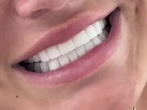 Mulher viraliza no TikTok com o novo visual de seus dentes feitos na Turquia