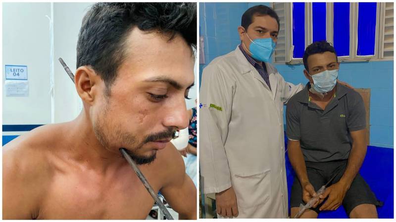 Homem sobrevive após ferro de arma caseira atravessar seu pescoço, no Pará