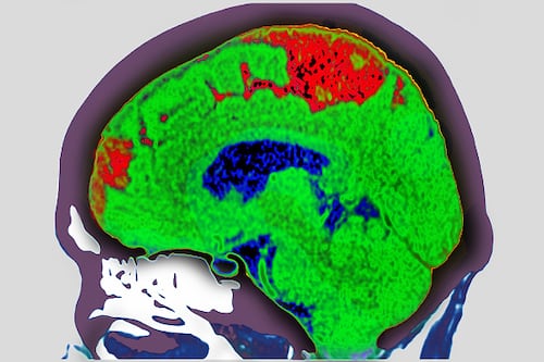 O que implica um derrame cerebral?