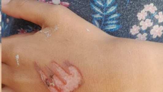 Menina também teve a mão queimada.