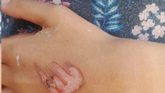 Menina também teve a mão queimada.