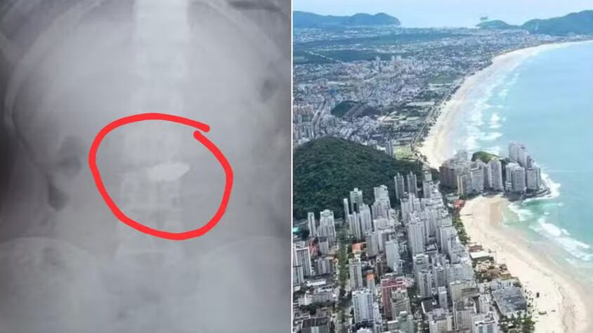 Menor furtou correntinha que acabou presa em seu estômago