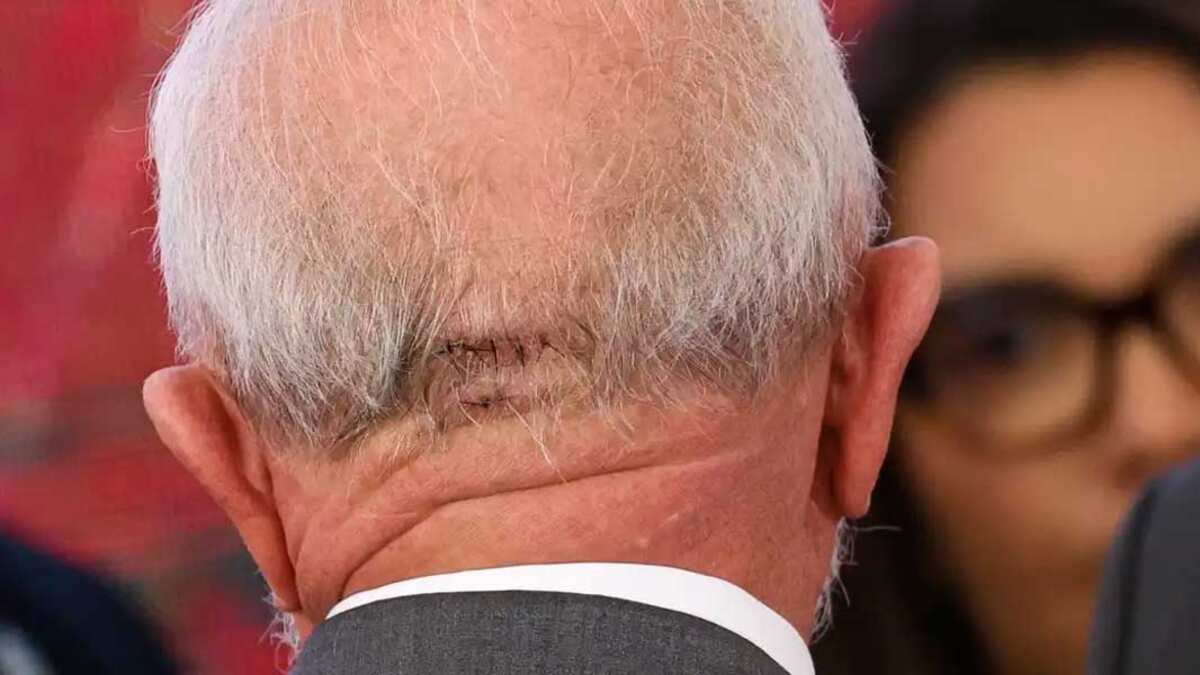Lula levou pontos na nuca após acidente doméstico