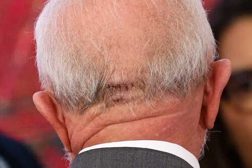 Entenda passo a passo o que aconteceu e como deve ser a recuperação de Lula