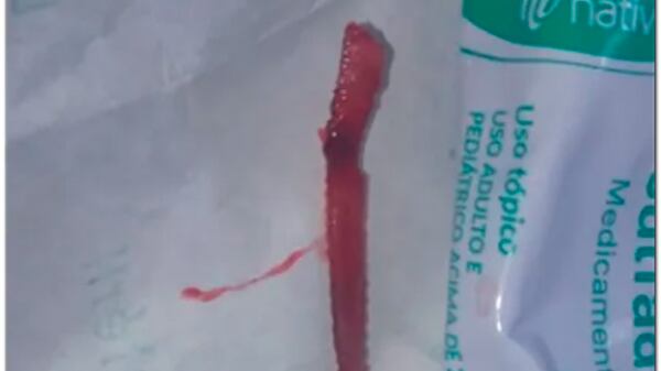 Ferrão retirado do pé da menina de 11 anos