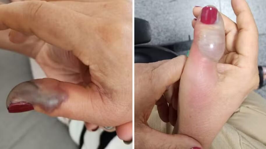 Mulher perde parte do dedo