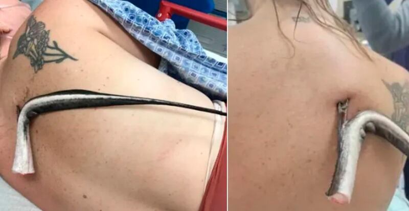 Mulher com ferrão de arraia preso ao corpo
