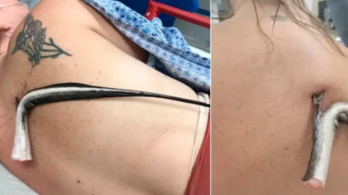 Mulher com ferrão de arraia preso ao corpo