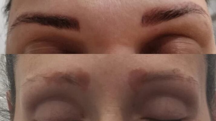 Mulheres realizam procedimento na sobrancelha e sofrem lesão no pulmão; entenda o caso