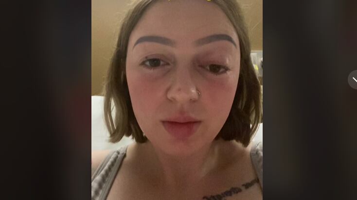 Mãe ‘termina’ sem olho ao fazer força intensa durante parto