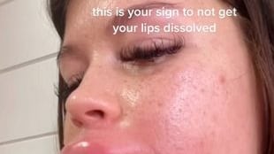 Mulher fica com boca inchada após tentar reverter preenchimento labial