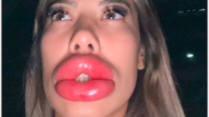 Americana teve reação alérgica à anestesia em procedimento de preenchimento labial