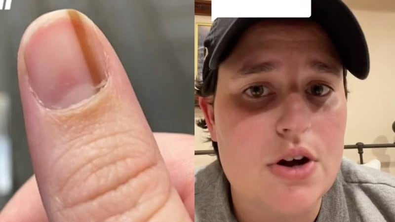 Mulher tinha marca ‘inofensiva’ em sua unha por 10 anos até que descobriu algo grave