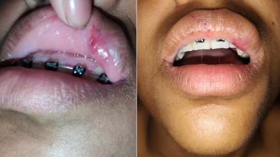 Garota teve várias lesões e precisou de atendimento médico.