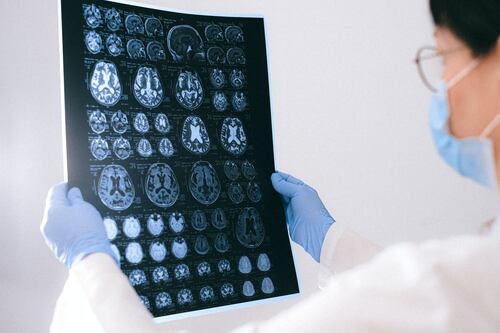 Cientistas descobrem como proteínas anormais causam morte de neurônios no Alzheimer