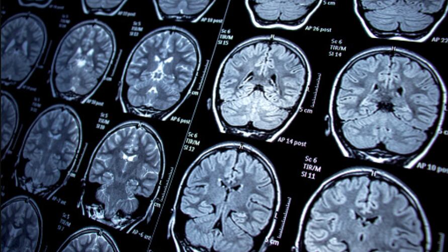 Jovem descobre que tem tumor cerebral após acontecer isso