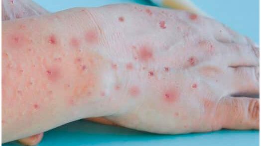 Braço com erupções de pele características da varíola dos macacos