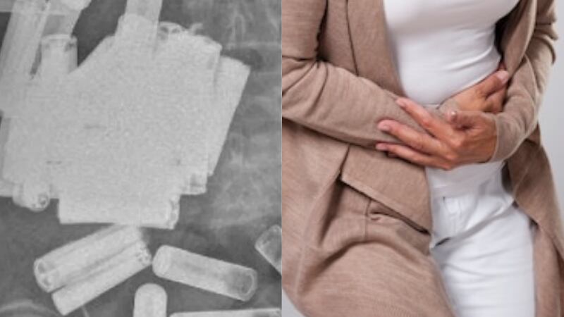 Idosa procura hospital com fortes dores e médicos descobrem 55 pilhas em seu estômago