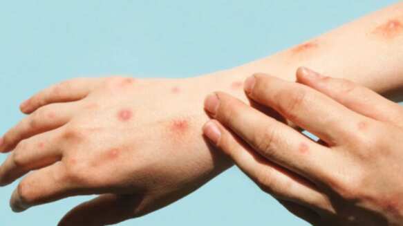 Emergência Global de Mpox: infectologista diz que fabricação de vacina é complexa, mas que transmissão ainda é baixa no Brasil