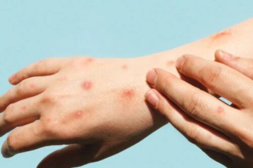 Emergência Global de Mpox: infectologista diz que fabricação de vacina é complexa e que transmissão ainda é baixa no Brasil