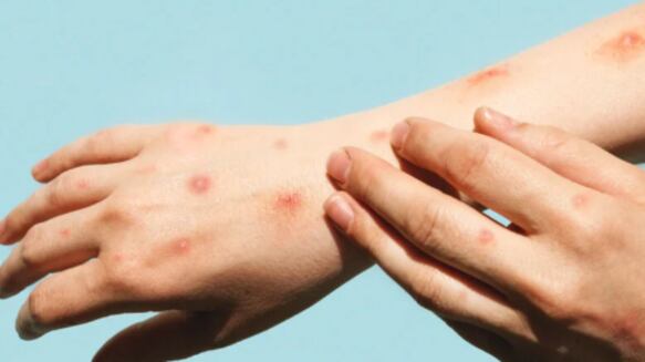 Emergência Global de Mpox: infectologista diz que fabricação de vacina é complexa, mas que transmissão ainda é baixa no Brasil