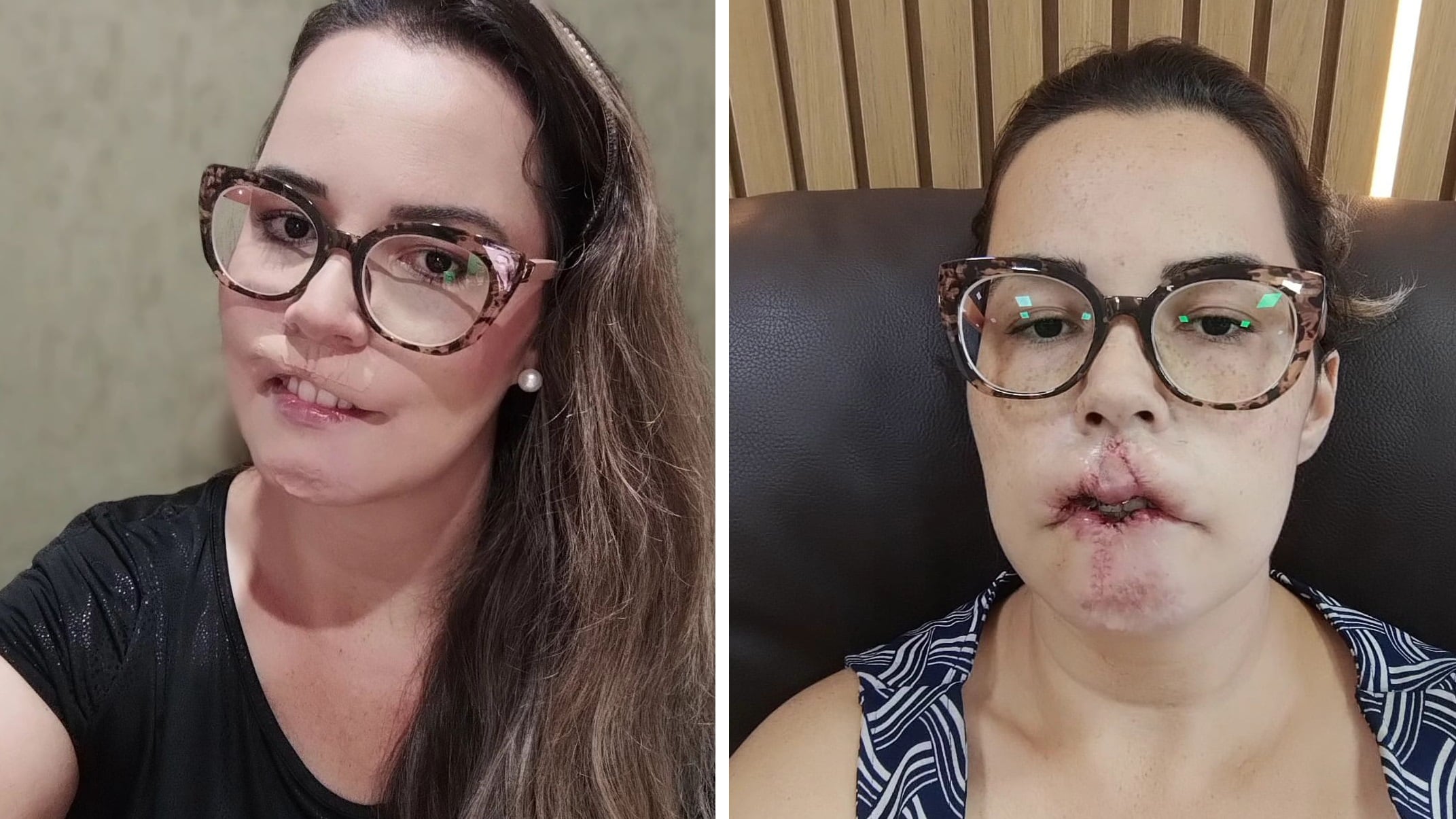 Influenciadora perdeu o lábio superior após procedimento