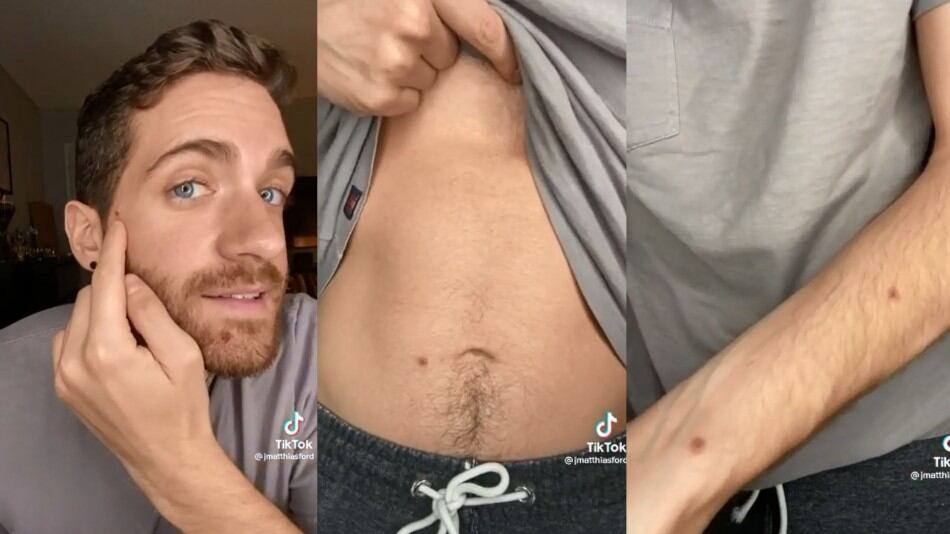 Ator Matt Ford mostra sinais causados pela Monkeypox