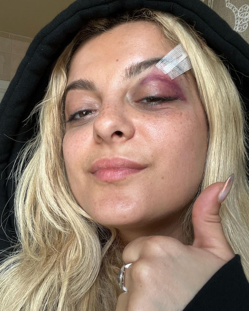 Bebe Rexha aparece irreconhecível após ser atingida no rosto por celular durante show