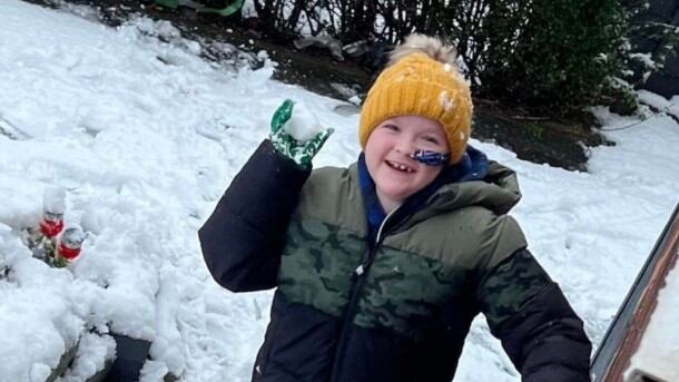 Criança de 8 anos desenvolveu alergia ao sol após transplante