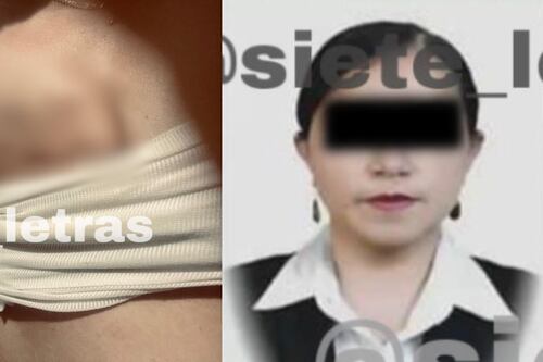 Mulher teve que amputar mama devido a erro médico