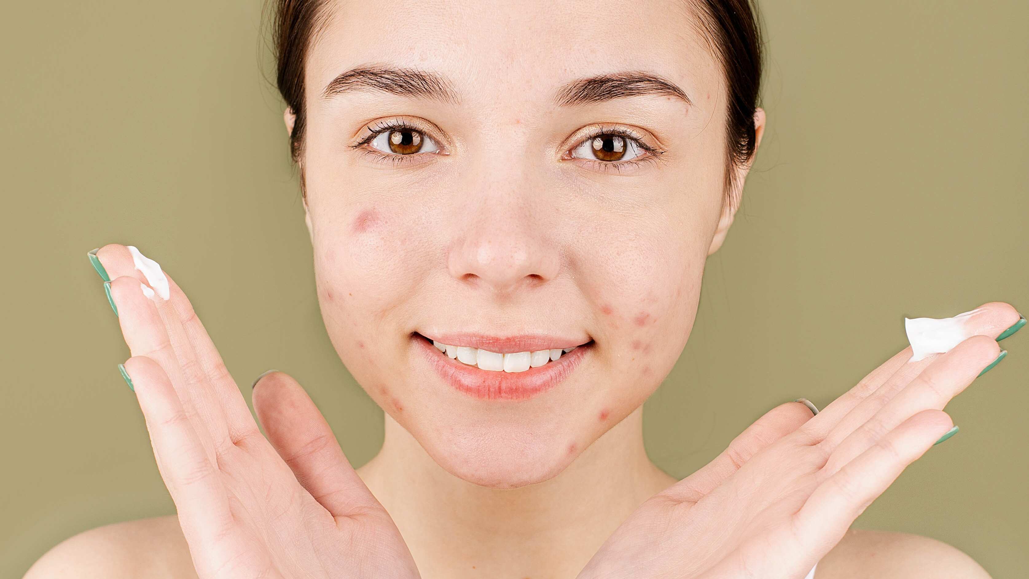 Mulher com espinhas utilizando creme no rosto