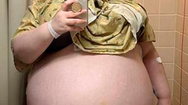 Mulher tinha tinha tumor gigante no ovário