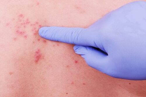 Herpes zoster afeta 99% dos idosos: tudo o que você precisa saber e como prevenir