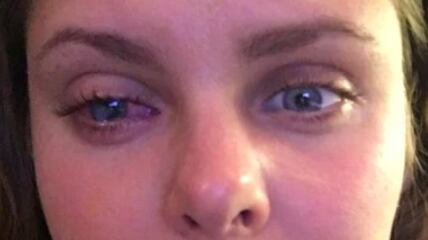 Sujeira em bolsa de maquiagem deixa mulher cega