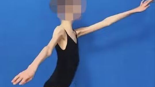 Justiça julga pais por negligência após jovem bailarina sofrer com extrema desnutrição