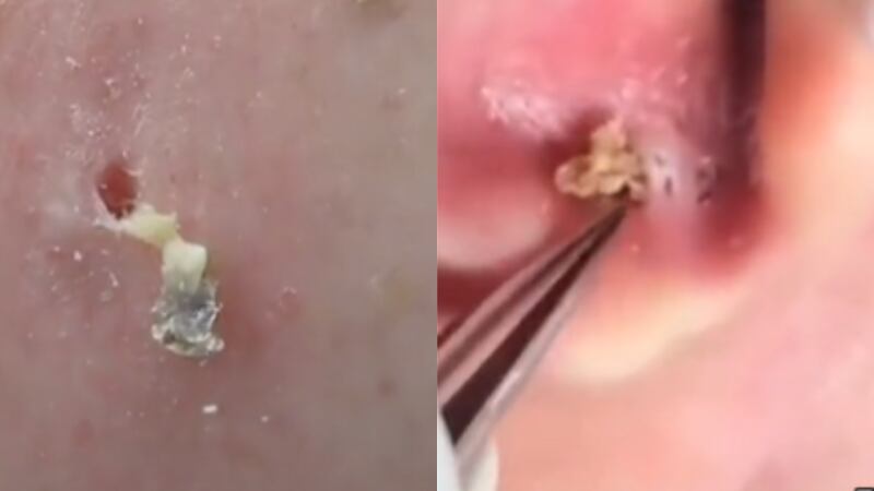 A lista de vídeos de cravos e espinhas gigantes que te deixará impressionado