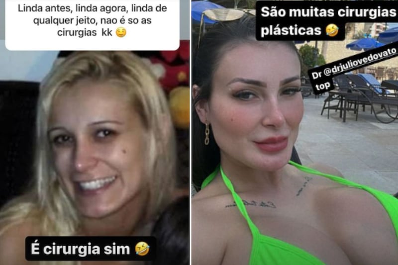 Recentemente ela fez lipo, retirou costelas e colocou 1 litro de silicone nos seios