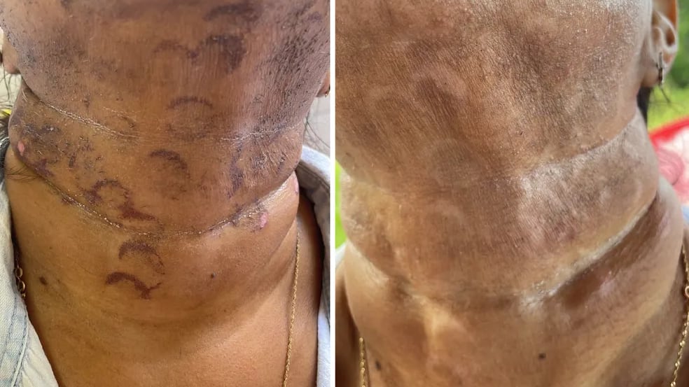 Professora sofre queimaduras no rosto durante sessão de depilação a laser