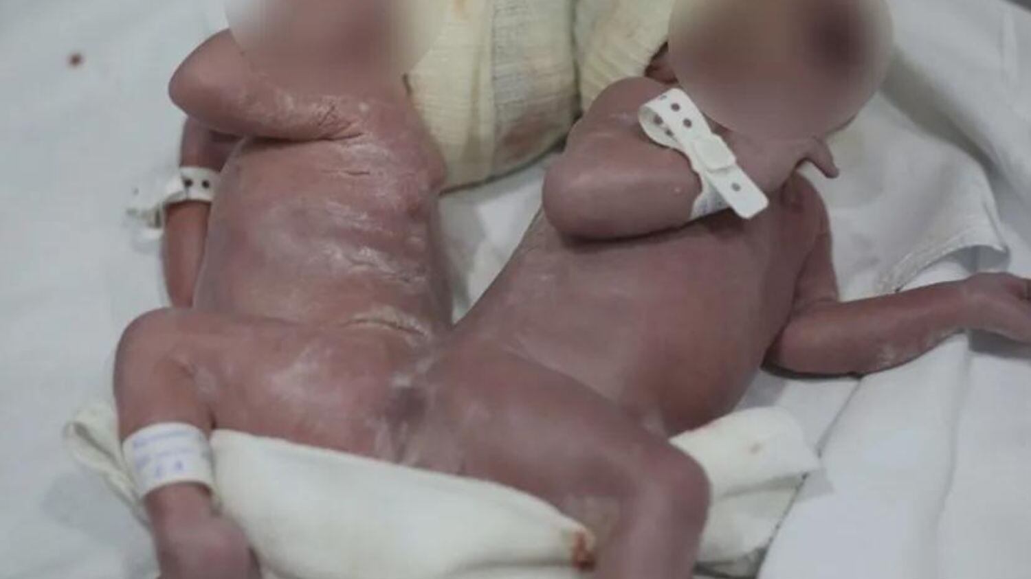 Médicos ainda estudam possibilidade de cirurgia