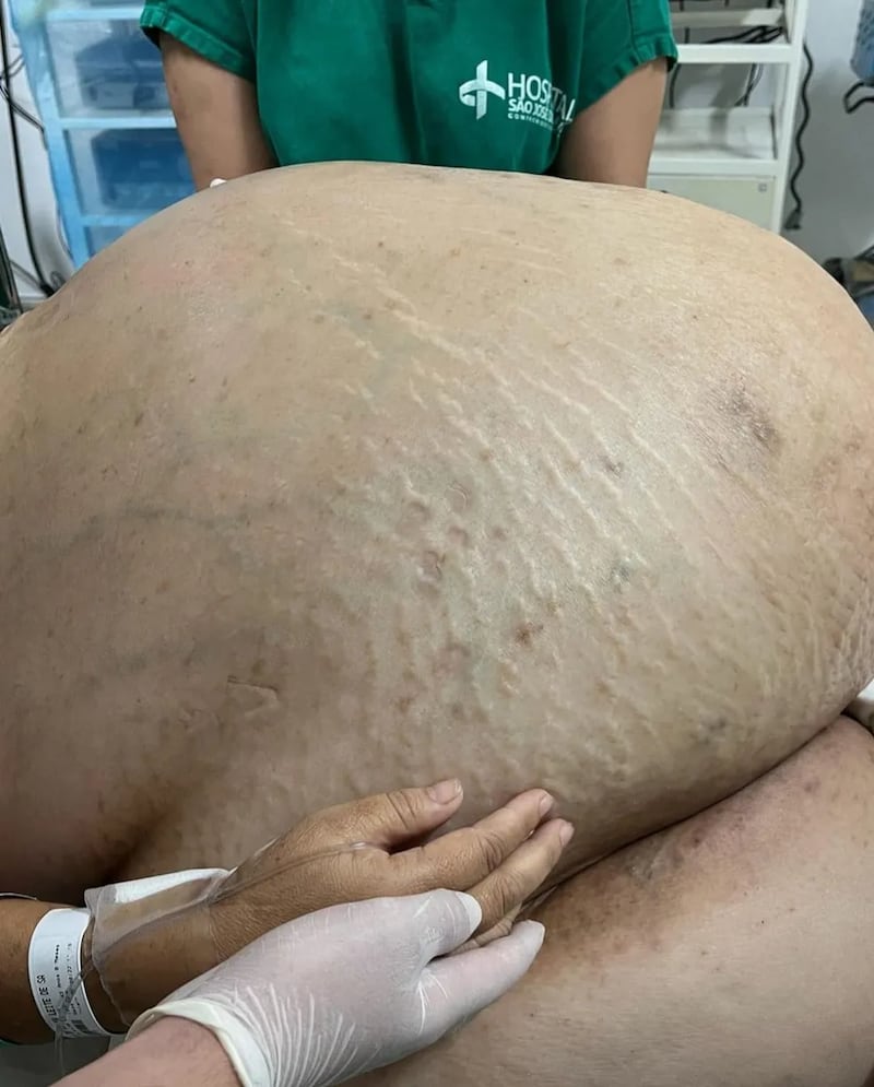 Mulher convivia com tumor de 46 kg