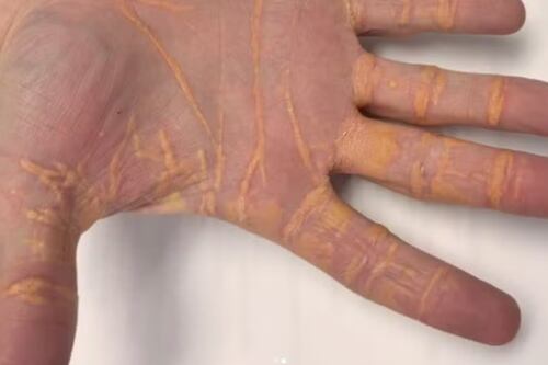 Dieta sem acompanhamento faz homem “transbordar” colesterol pelas mãos e preocupa médicos