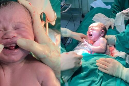 Essa é a verdade por trás do bebê que nasceu com seis dentes no Mato Grosso do Sul