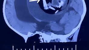 Feto é encontrado em crânio de bebê de um ano, que não sobreviveu à cirurgia de retirada