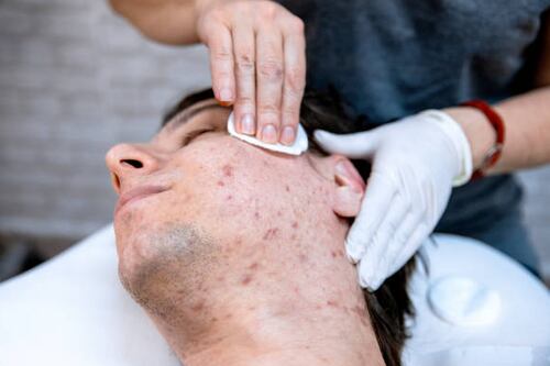 Controle da acne e oleosidade: descubra os tratamentos mais indicados para pele masculina