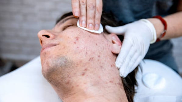 Tratamentos para controle da acne e oleosidade em homens