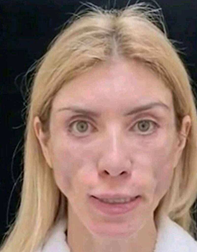 O rosto da modelo ficou completamente desfigurado após a cirurgia