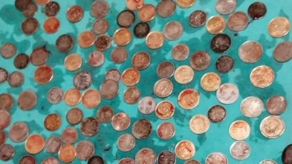 187 moedas foram retiradas do estômago do homem