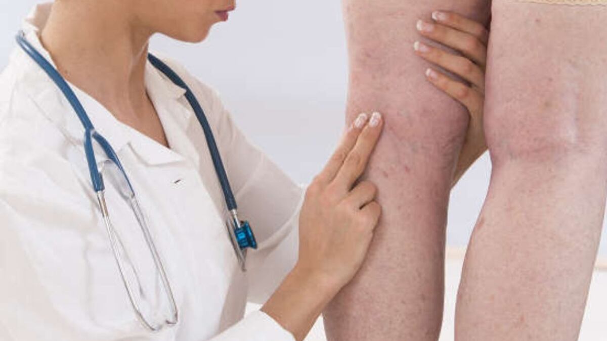 Las várices no discriminan a nadie: Qué son y cómo prevenirlas